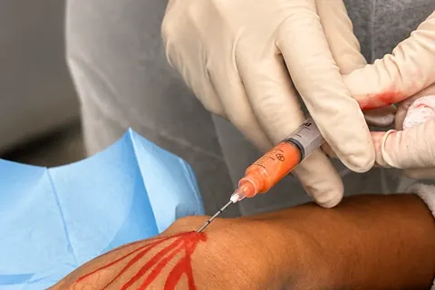 Rejuvenescimento de mãos em Brasília — protocolo e avaliação