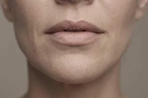 Preenchimento labial em Brasília — protocolo e avaliação