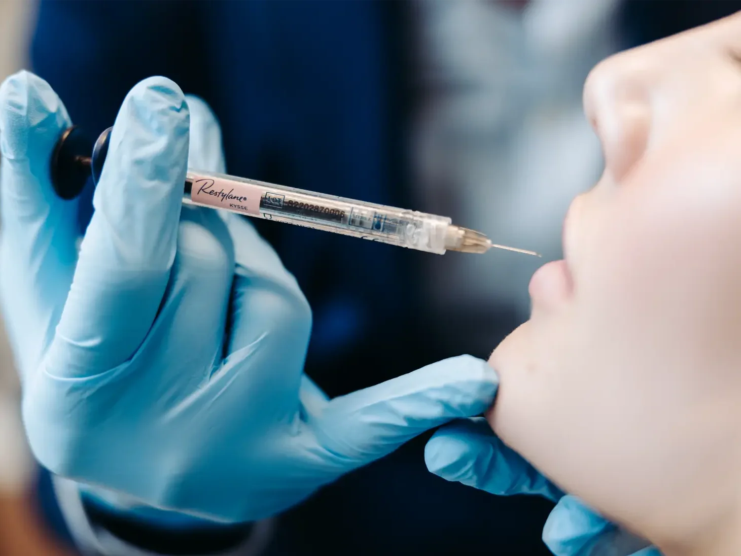 Aplicação de preenchedor labial Restylane Kysse para definição e volume natural em Brasília